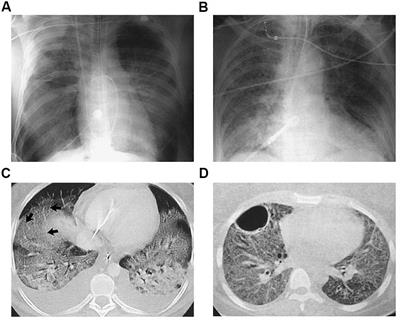 Metabolic Imaging and Biological Assessment: Platforms to Evaluate Acute Lung Injury and Inflammation